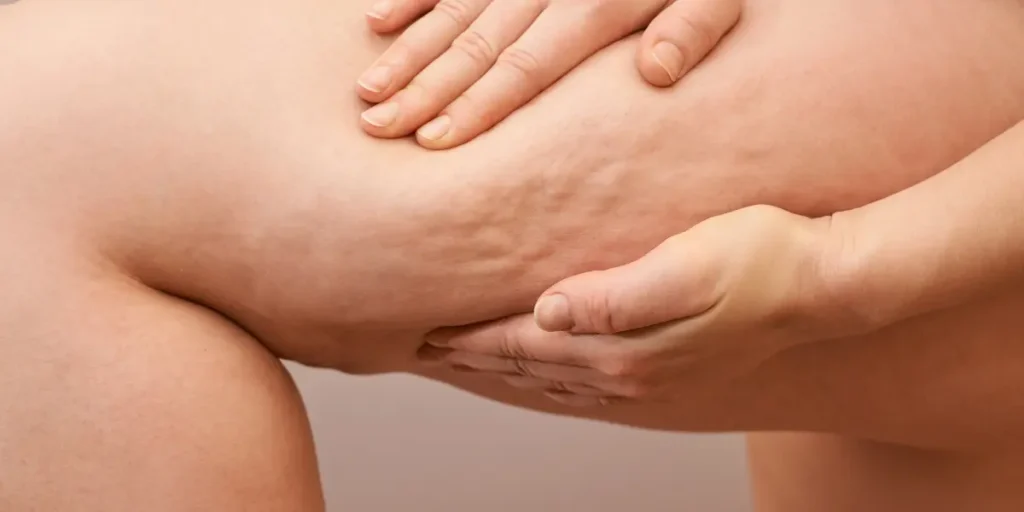 O que é lipedema e como tratar