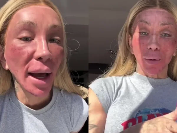 Maya Massafera exibe rosto inchado após peeling: 'Nunca inchou tanto