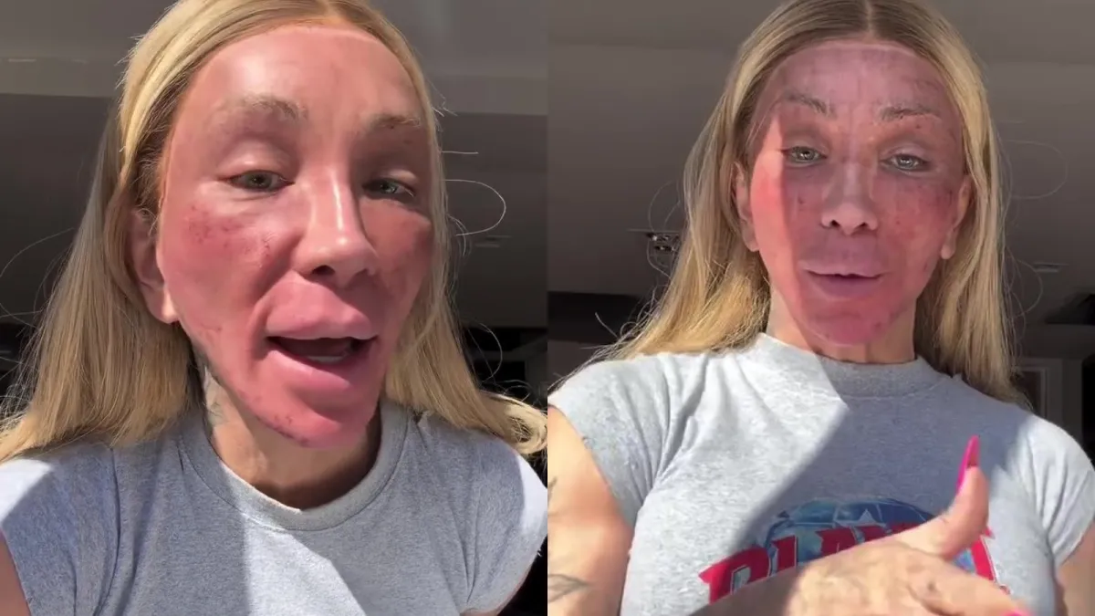 Maya Massafera exibe rosto inchado após peeling: 'Nunca inchou tanto