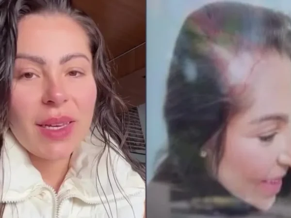 Andressa Ferreira revela queda de cabelo com caneta emagrecedora