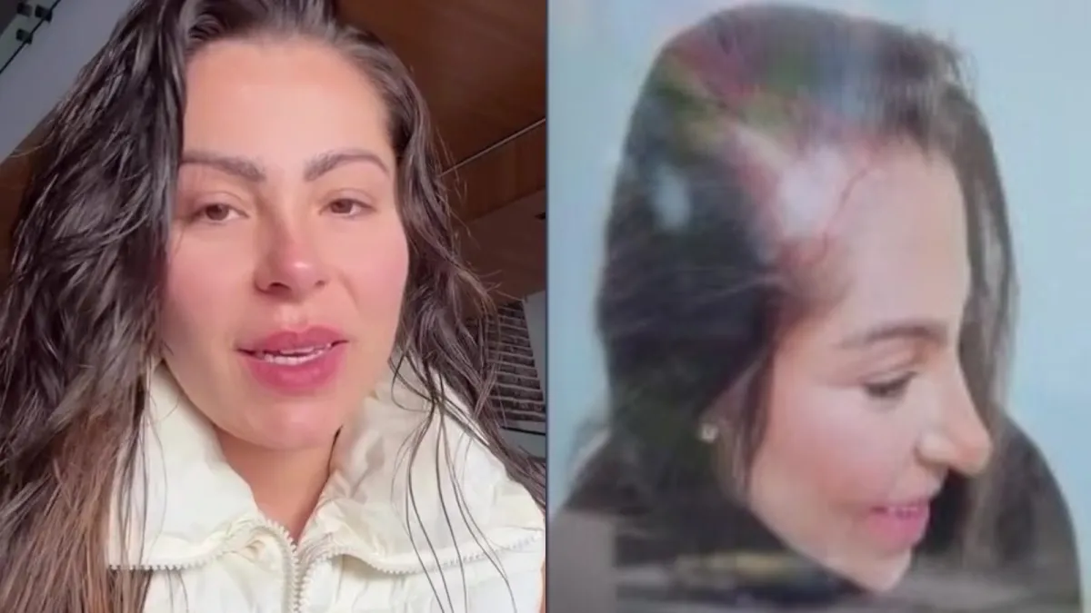 Andressa Ferreira revela queda de cabelo com caneta emagrecedora