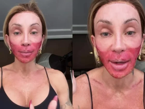Maya Massafera rebate críticas após novo peeling: 'Tenho que fazer