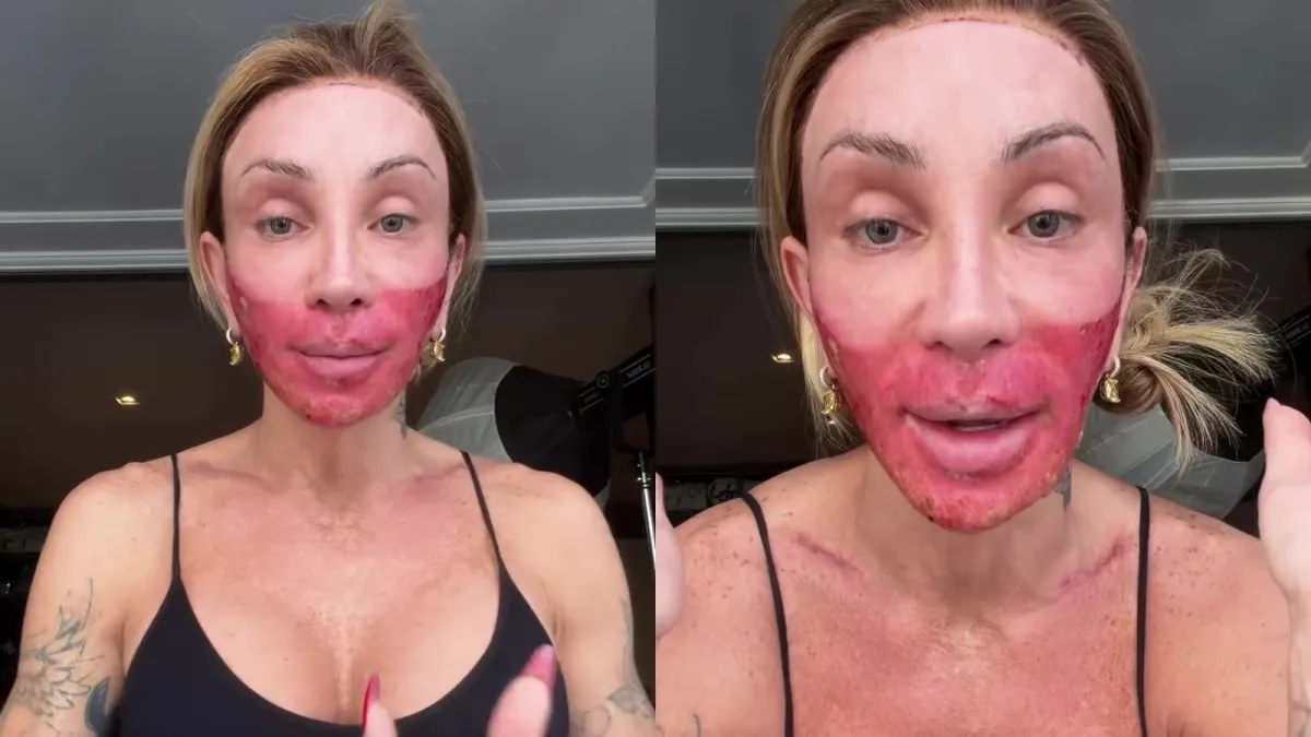 Maya Massafera rebate críticas após novo peeling: 'Tenho que fazer